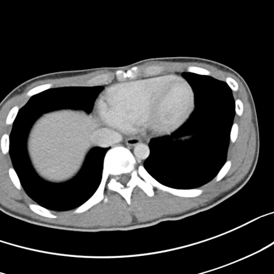 File:Acute appendicitis (Radiopaedia 32614-33572 Axial C+ portal venous phase 2).jpg