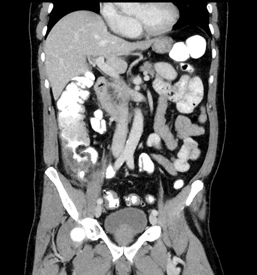 File:Acute appendicitis (Radiopaedia 77016-88960 Coronal C+ portal venous phase 48).jpg