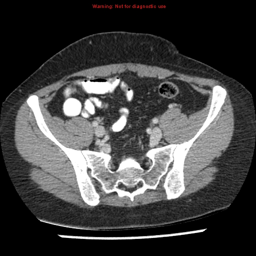 File:Acute appendicitis (Radiopaedia 7966-8812 C+ portal venous phase 40).jpg