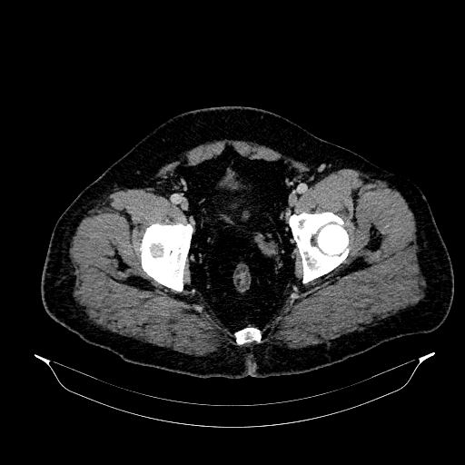 File:Acute appendicitis (Radiopaedia 79950-93224 Axial C+ portal venous phase 93).jpg