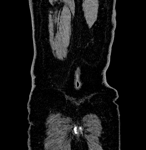 Acute appendicitis (Radiopaedia 79950-93224 Coronal C+ portal venous phase 96).jpg
