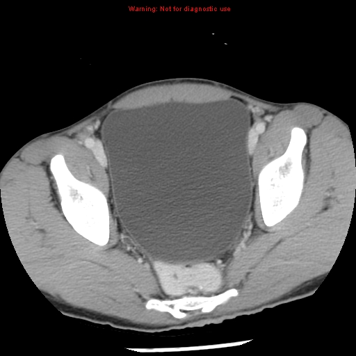 Acute appendicitis (Radiopaedia 8195-9045 Axial C+ portal venous phase 66).jpg