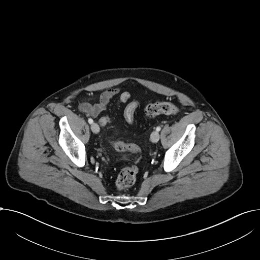 File:Acute appendicitis - large appendicoliths (Radiopaedia 61805-69820 Axial C+ portal venous phase 110).jpg