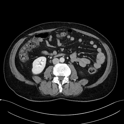 Acute appendicitis - large appendicoliths (Radiopaedia 61805-69820 Axial C+ portal venous phase 67).jpg