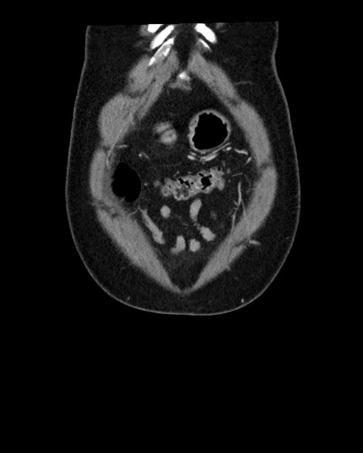 Acute appendicitis - large appendicoliths (Radiopaedia 61805-69820 Coronal C+ portal venous phase 19).jpg