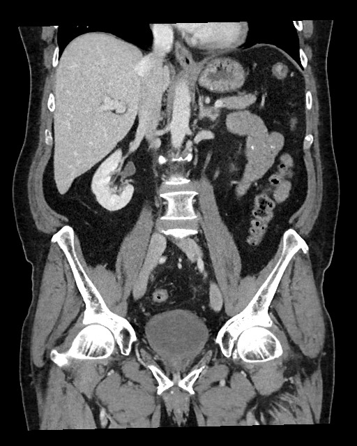 Acute appendicitis - large appendicoliths (Radiopaedia 61805-69820 Coronal C+ portal venous phase 72).jpg