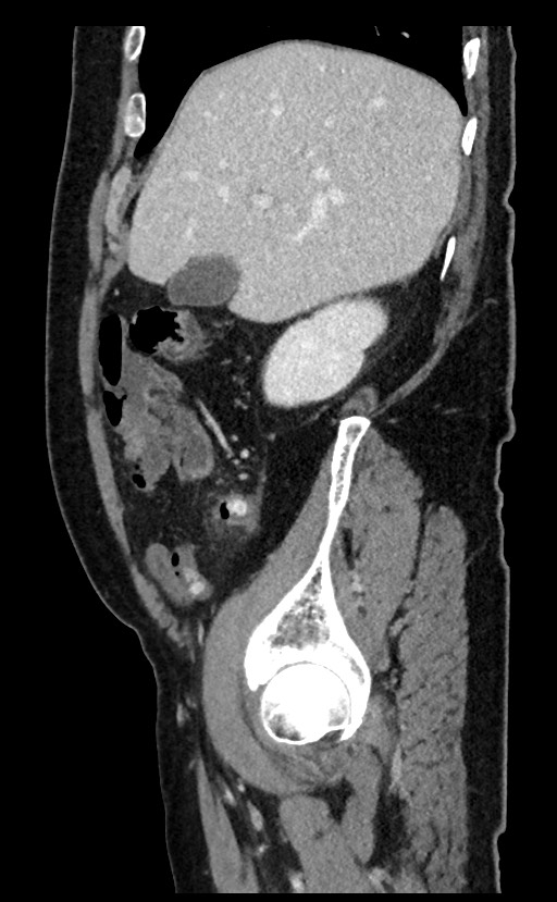 Acute appendicitis - large appendicoliths (Radiopaedia 61805-69820 Sagittal C+ portal venous phase 88).jpg