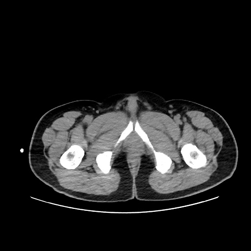 File:Acute appendicitis and COVID 19 pneumonia (Radiopaedia 76604-88380 Axial non-contrast 126).jpg