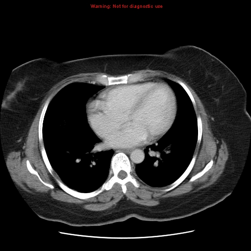File:Acute appendicitis complicated by ovarian vein thrombophlebitis (Radiopaedia 16172-15851 Axial C+ portal venous phase 6).jpg