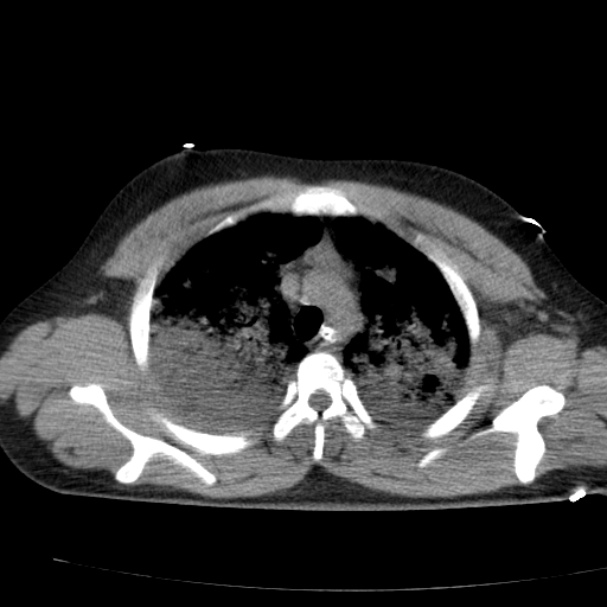 Acute aspiration pneumonitis (Radiopaedia 33605-34703 Axial non-contrast 32).jpg