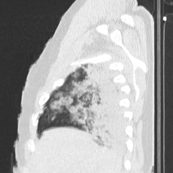 Acute aspiration pneumonitis (Radiopaedia 33605-34703 Sagittal lung window 18).jpg