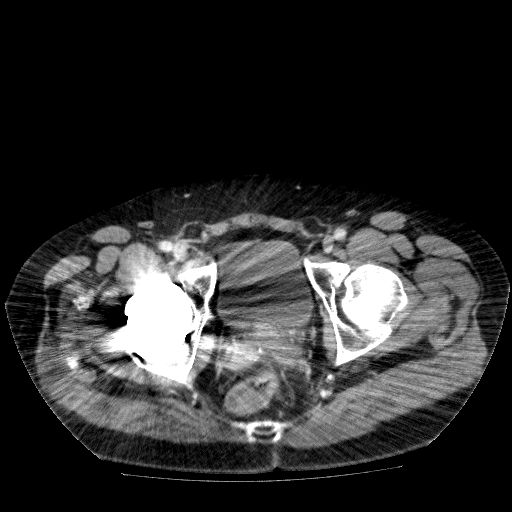 File:Acute cholecystitis and incidental left sided IVC (Radiopaedia 49352-54459 Axial C+ portal venous phase 148).jpg