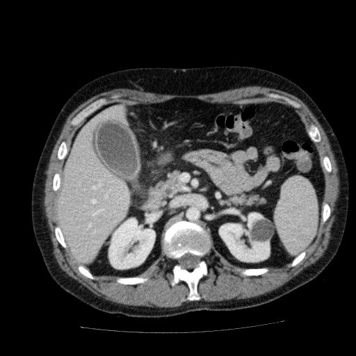 File:Acute cholecystitis and incidental left sided IVC (Radiopaedia 49352-54459 Axial C+ portal venous phase 58).jpg