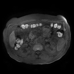 Acute cholecystitis complicated by pylephlebitis (Radiopaedia 65782-74915 Axial T1 fat sat 72).jpg