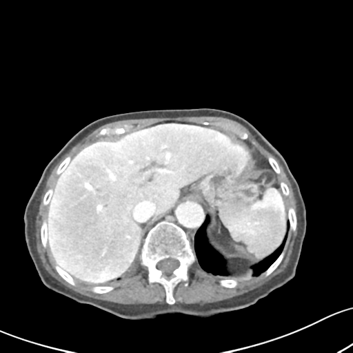 Acute cholecystitis with contained perforation (Radiopaedia 47328-51907 Axial C+ portal venous phase 16).png