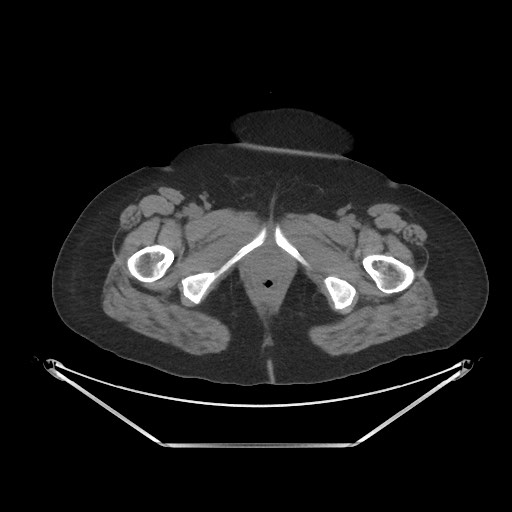 Acute cholecystitis with tensile fundus sign (Radiopaedia 71394-81723 Axial non-contrast 125).jpg