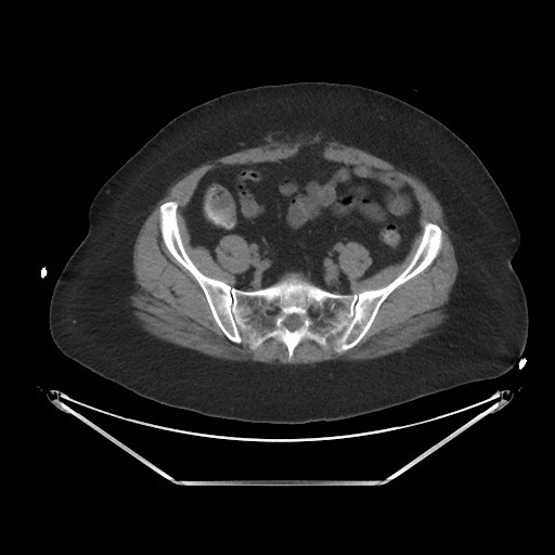 File:Acute cholecystitis with tensile fundus sign (Radiopaedia 71394-81723 Axial non-contrast 87).jpg
