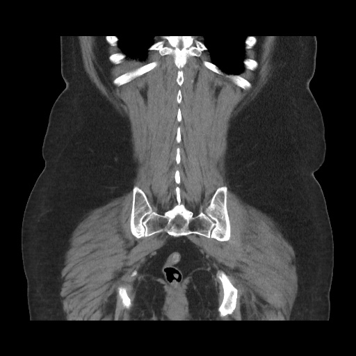 File:Acute cholecystitis with tensile fundus sign (Radiopaedia 71394-81723 Coronal non-contrast 98).jpg