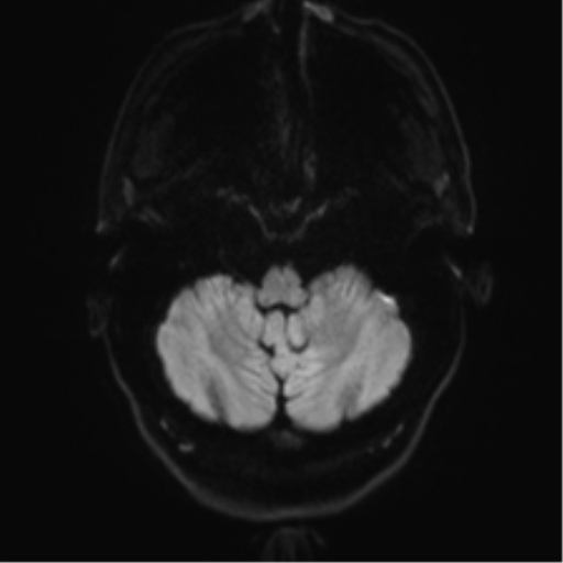 File:Acute disseminated encephalomyelitis (ADEM) (Radiopaedia 65319-74350 Axial DWI 3).png
