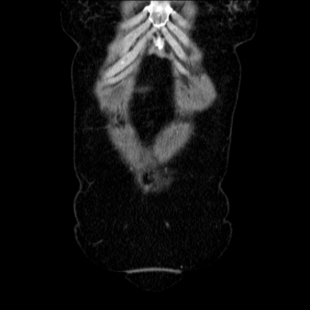 Acute diverticulitis (Radiopaedia 34183-35442 Coronal C+ portal venous phase 13).jpg