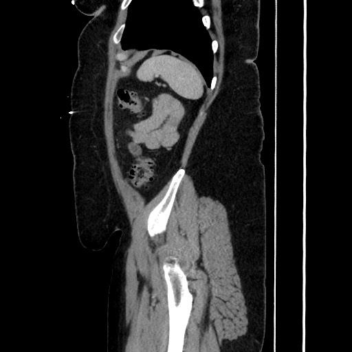 Acute diverticulitis - transverse colon (Radiopaedia 87063-103327 Sagittal C+ portal venous phase 178).jpg