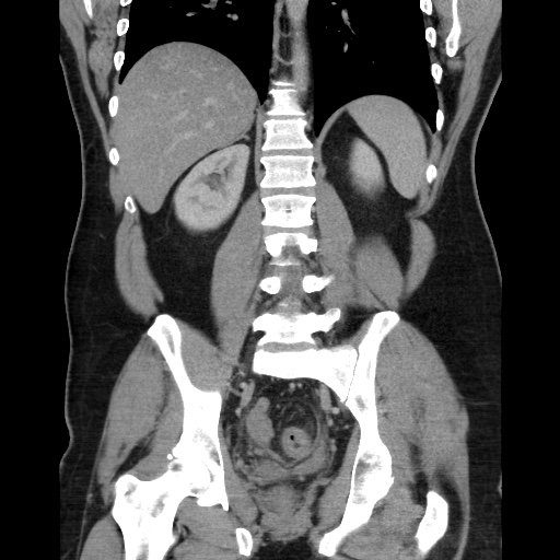 Acute diverticulitis with localized perforation (Radiopaedia 41296-44113 Coronal C+ portal venous phase 43).jpg