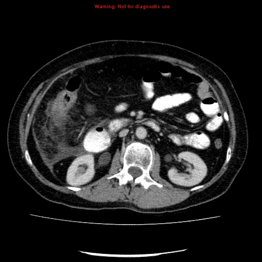 Acute gangrenous cholecystitis (Radiopaedia 10123-10661 Axial C+ portal venous phase 44).jpg