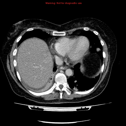 Acute gangrenous cholecystitis (Radiopaedia 10123-10661 Axial C+ portal venous phase 9).jpg