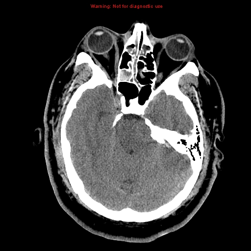 File:Acute hemorrhagic leukoencephalitis (Radiopaedia 14076-13920 Axial non-contrast 15).jpg