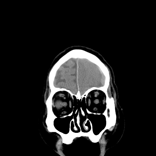 Acute hemorrhagic stroke (Radiopaedia 17507-17223 Coronal non-contrast 6).jpg
