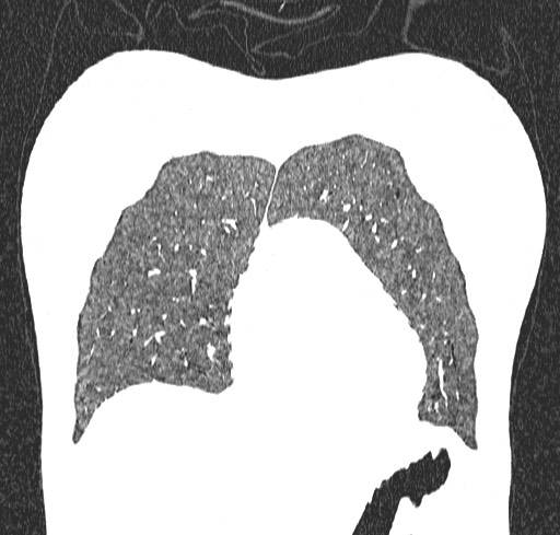 Acute hypersensitivity pneumonitis (Radiopaedia 85293-100870 Coronal lung window 20).jpg
