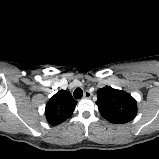 Acute longus colli calcific tendinitis (Radiopaedia 72495-83036 Axial C+ arterial phase 88).jpg