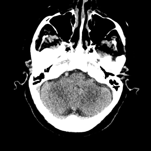 Acute middle cerebral artery territory infarct (Radiopaedia 52380-58283 Axial non-contrast 19).jpg
