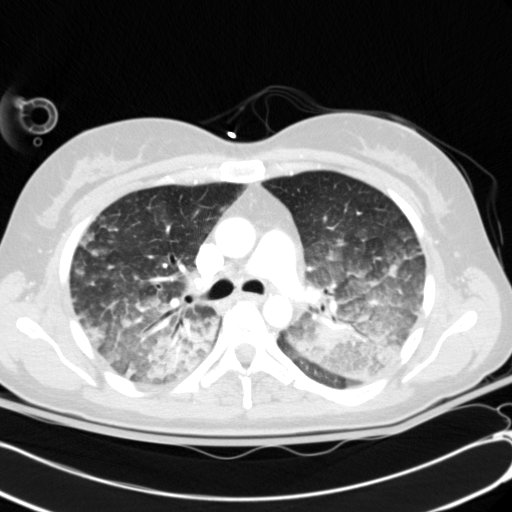 Acute myocardial infarction in CT (Radiopaedia 39947-42415 Axial lung window 46).jpg