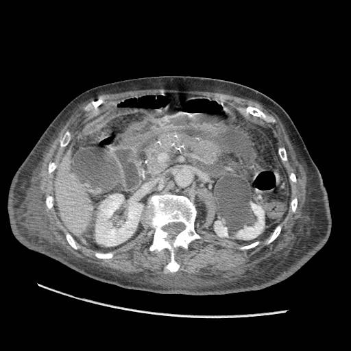 Acute on chronic pancreatitis (Radiopaedia 13233-13244 Axial C+ portal venous phase 40).jpg