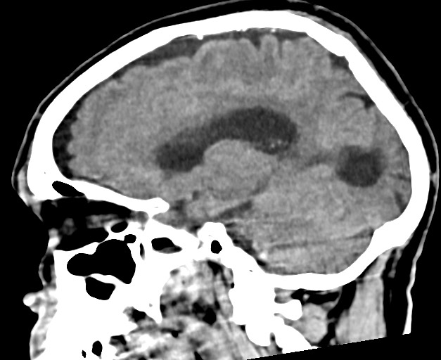 Acute on chronic subdural hematoma (Radiopaedia 78346-90966 Sagittal non-contrast 25).jpg