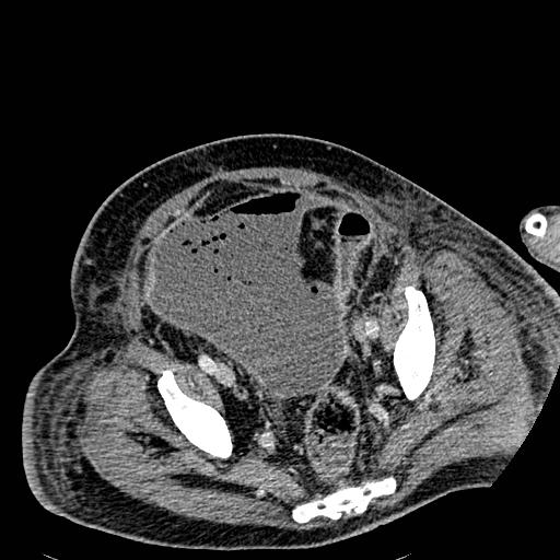 Acute pancreatic necrosis (Radiopaedia 13560-18501 Axial C+ portal venous phase 126).jpg