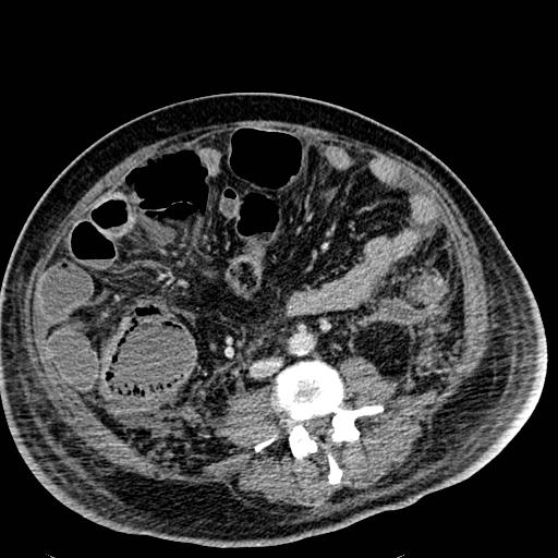 Acute pancreatic necrosis (Radiopaedia 13560-18501 Axial C+ portal venous phase 85).jpg