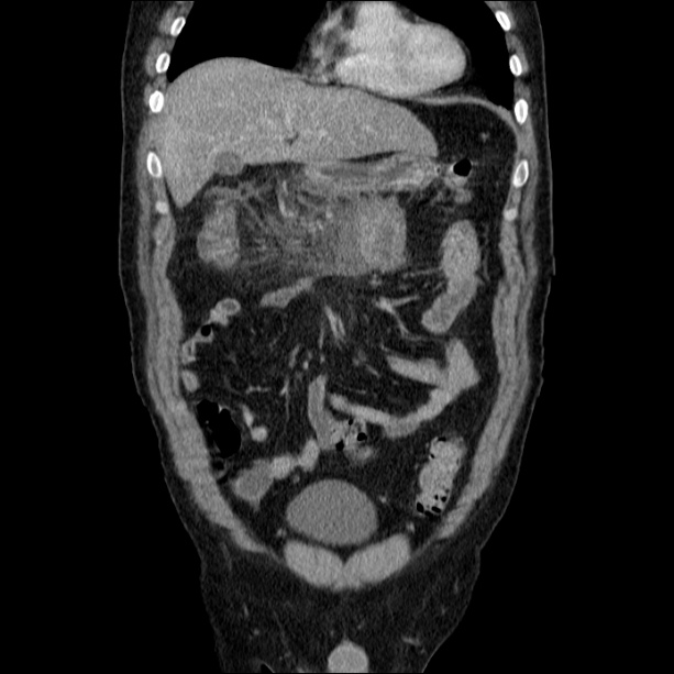 Acute pancreatitis (Radiopaedia 26663-26813 Coronal C+ portal venous phase 20).jpg