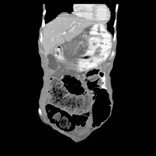File:Acute pancreatitis (Radiopaedia 50213-55558 Coronal C+ portal venous phase 3).jpg