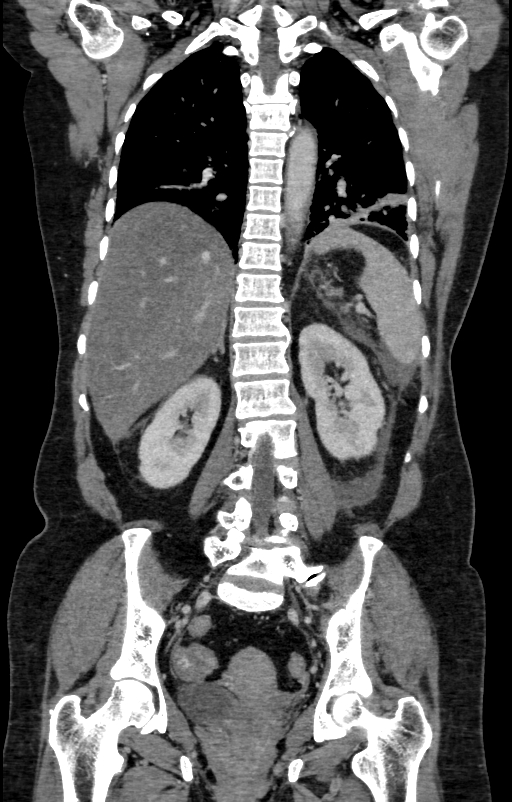 Acute pancreatitis (Radiopaedia 80007-93285 Coronal C+ portal venous phase 106).jpg