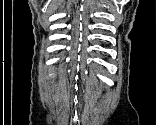Acute pancreatitis (Radiopaedia 85146-100701 Coronal C+ portal venous phase 72).jpg