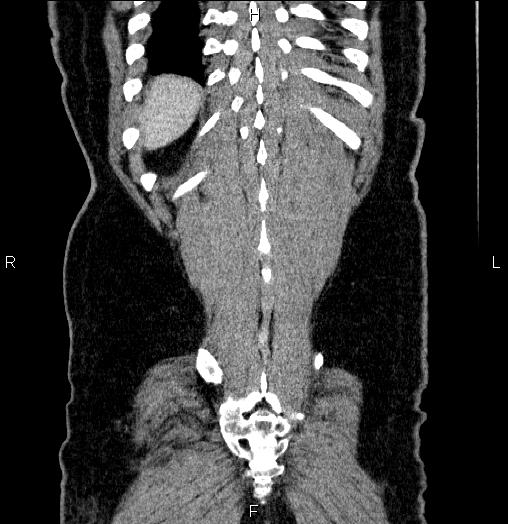 Acute pancreatitis (Radiopaedia 85390-101010 Coronal C+ portal venous phase 67).jpg