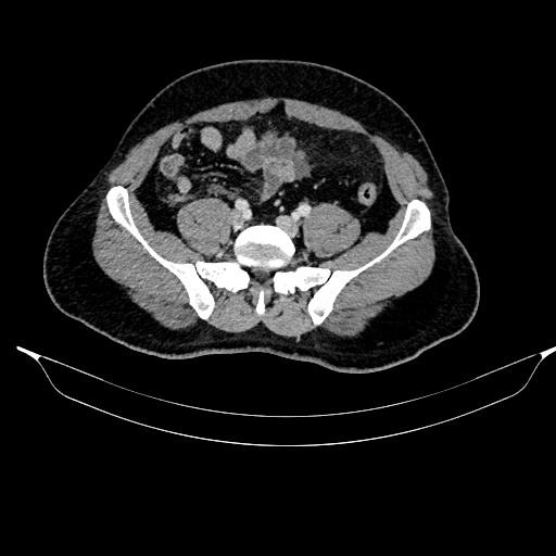 File:Acute pancreatitis (Radiopaedia 87428-103757 Axial C+ portal venous phase 72).jpg