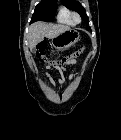 Acute pancreatitis (Radiopaedia 87428-103757 Coronal C+ portal venous phase 17).jpg