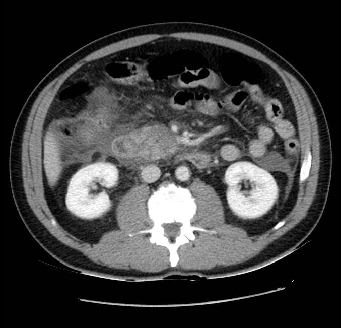 Acute pancreatitis - Balthazar E (Radiopaedia 23080-23110 Axial C+ portal venous phase 32).jpg
