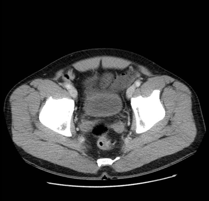 Acute pancreatitis - Balthazar E (Radiopaedia 23080-23110 Axial C+ portal venous phase 66).jpg