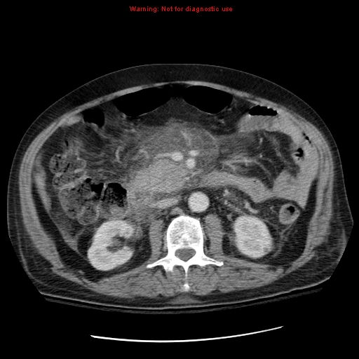 File:Acute pancreatitis with incidental pancreatic lipoma (Radiopaedia 10190-10730 Axial C+ portal venous phase 32).jpg