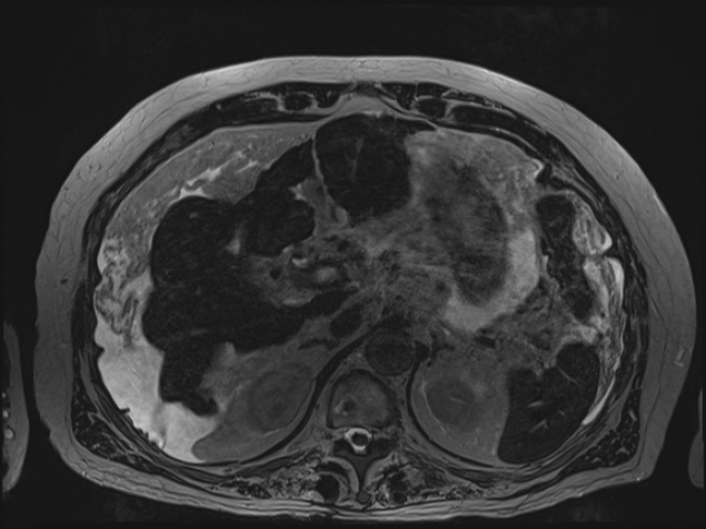 Acute portal vein thrombosis (Radiopaedia 73198-83925 Axial Heavily T2 thin cuts 25).jpg