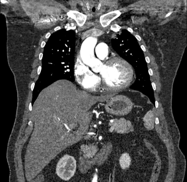 Acute pulmonary embolism with pulmonary infarcts (Radiopaedia 77688-89908 Coronal C+ CTPA 31).jpg